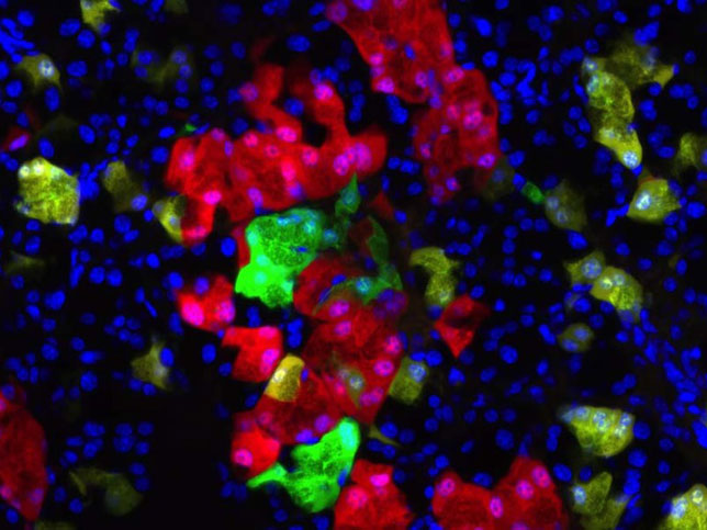 Modeling the Growth of a Tumor. Although it is known that certain gene mutations trigger tumor formation, the subsequent cellular events driving cancer progression are not well understood. Cell-specific fluorescence allow us to track cells over the course of cancer development. Image shows mutated (green) and non-mutated (red and yellow) cells in a pancreas.
